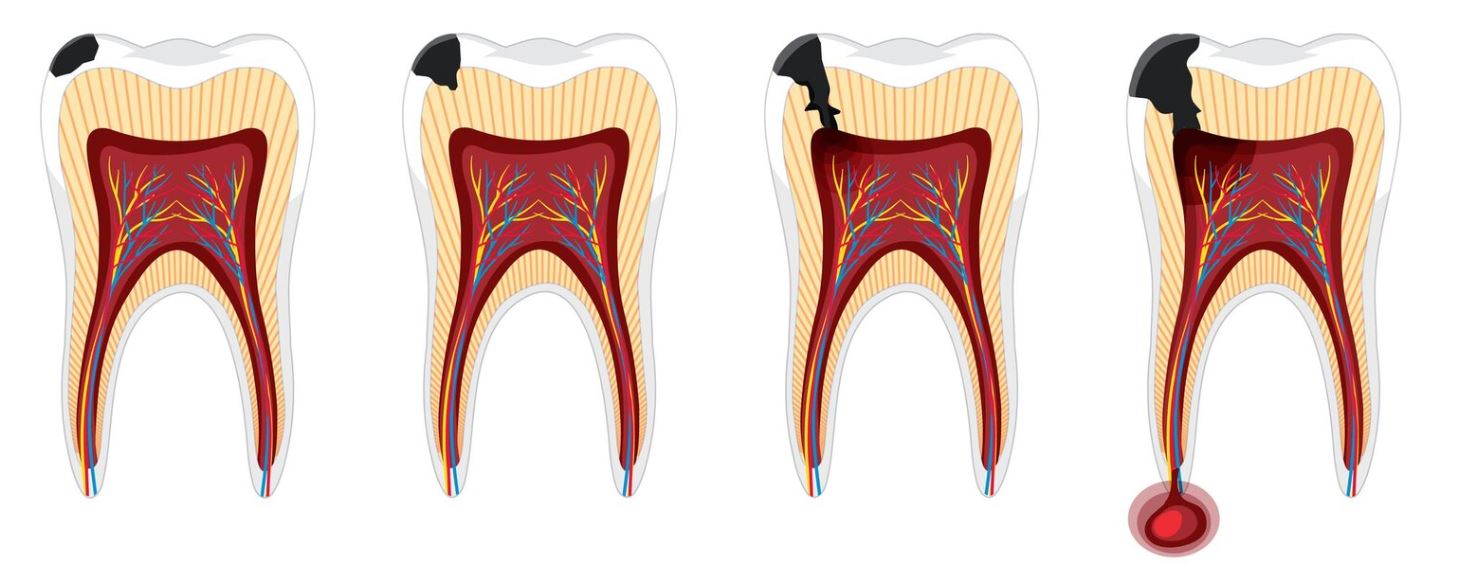 Les différents stades de la carie