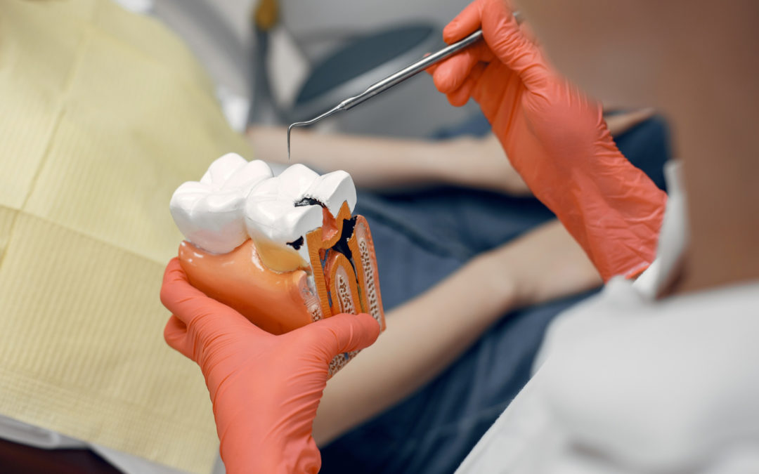 Un dentiste avec des gants orange utilise une sonde pour montrer les dommages causés par une carie sur une maquette de dent géante.