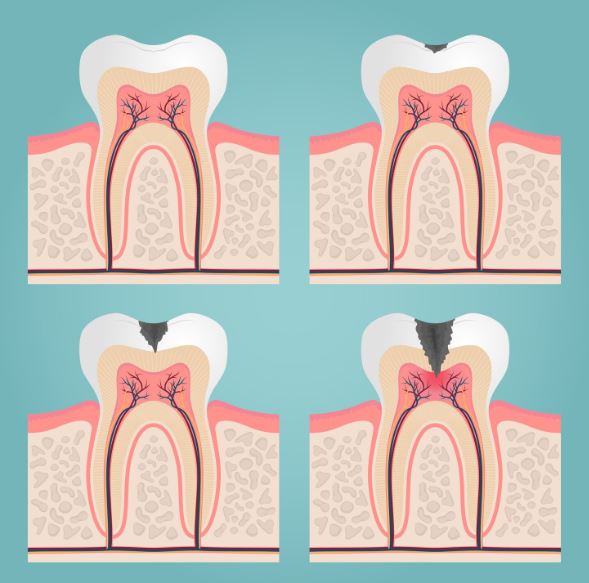 Infographie pédagogique sur les quatre stades d'évolution d'une carie dentaire